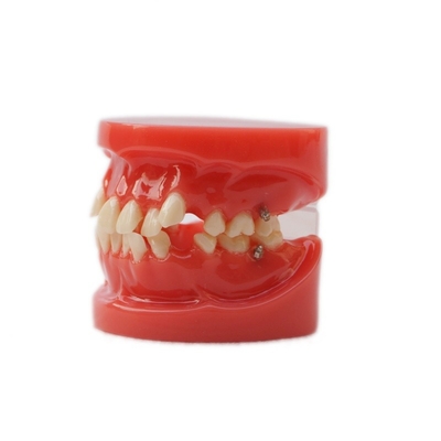 Formation à l'utilisation des dents Dentistique Modèle d'enseignement Modèle d'orthodontie dentaire fonctionnelle sans support
